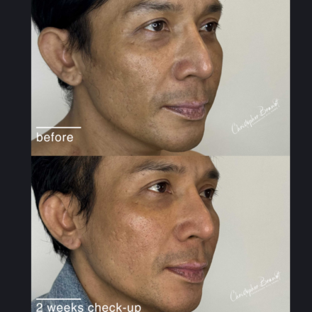 Before and after regenerative facial treatment using stem cells, Seffiller, lipofilling, micro- and nanofat in Amsterdam