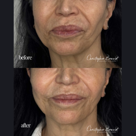 Stem cells regenerative facial before after amsterdam 4