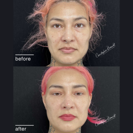 Before and after regenerative facial treatment using stem cells, Seffiller, lipofilling, micro- and nanofat in Amsterdam