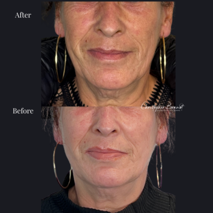 Before and after regenerative facial treatment using stem cells, Seffiller, lipofilling, micro- and nanofat combined with Radiesse collagen-stimulating filler in Amsterdam
