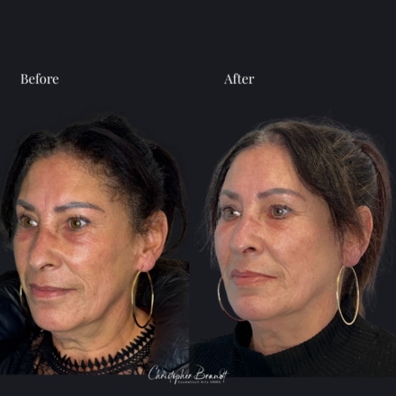 Before and after regenerative facial treatment using stem cells, Seffiller, lipofilling, micro- and nanofat combined with Radiesse collagen-stimulating filler in Amsterdam