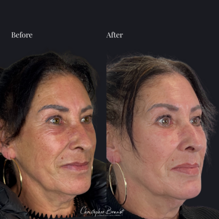 Before and after regenerative facial treatment using stem cells, Seffiller, lipofilling, micro- and nanofat combined with Radiesse collagen-stimulating filler in Amsterdam
