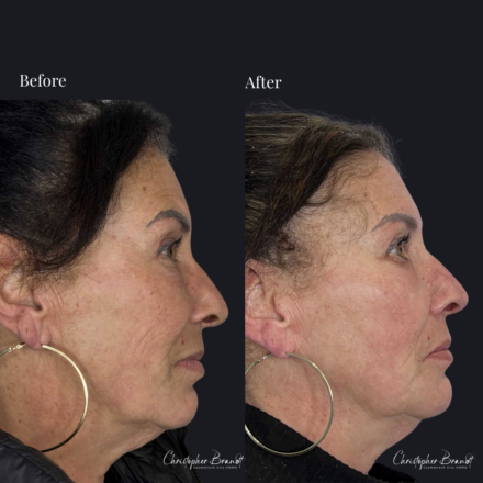 Before and after regenerative facial treatment using stem cells, Seffiller, lipofilling, micro- and nanofat combined with Radiesse collagen-stimulating filler in Amsterdam