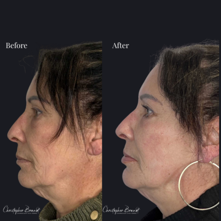Before and after regenerative facial treatment using stem cells, Seffiller, lipofilling, micro- and nanofat combined with Radiesse collagen-stimulating filler in Amsterdam