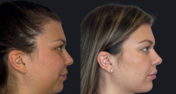 Body Contouring behandeling met liposuctie en QuantumRF