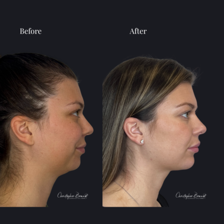Before and after regenerative facial treatment using underchin liposuction and Quantum RF for fat reduction and skin tightening in Amsterdam