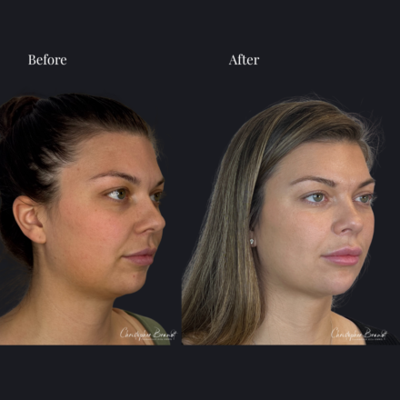 Before and after regenerative facial treatment using underchin liposuction and Quantum RF for fat reduction and skin tightening in Amsterdam