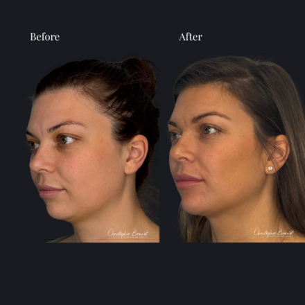 Before and after regenerative facial treatment using underchin liposuction and Quantum RF for fat reduction and skin tightening in Amsterdam