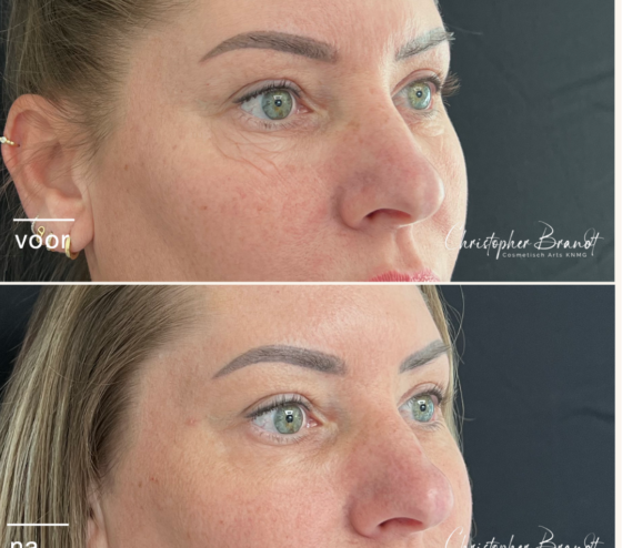 Before and after Plexr treatment bij Kliniek Dokter Brandt in Amsterdam