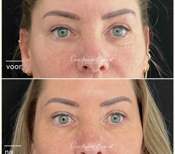 Before and after Plexr treatment bij Kliniek Dokter Brandt in Amsterdam