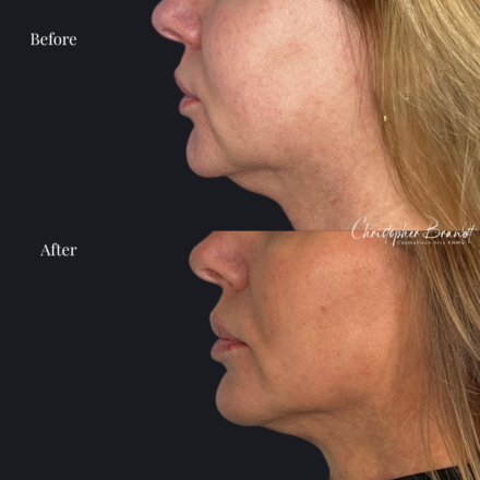 Resultaten van Quantum RF liposuctie bij de onderkin – voor en na behandeling bij Dr. Brandt in Amsterdam