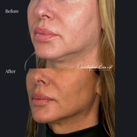 Voor en na quantum rf liposuctie onderkin – dr. brandt amsterdam 2