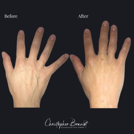 Before and after hand treatment at Brandt clinic