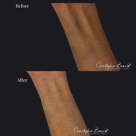 Resultaat van hand- en armverjonging behandeling bij Kliniek Dokter Brandt in Amsterdam
