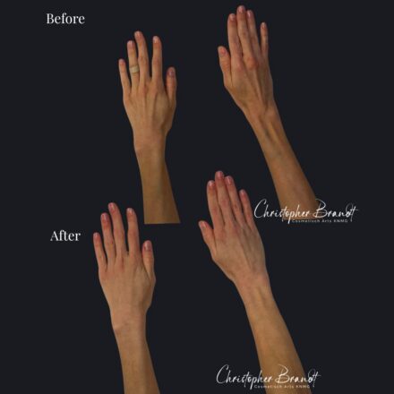 Handen armen verjonging kliniek dokter brandt amsterdam.4.jpg