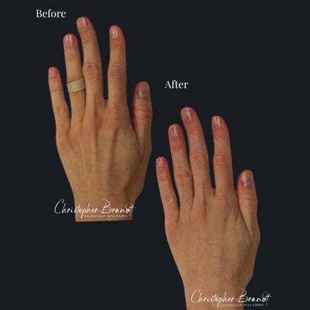 Handen armen verjonging kliniek dokter brandt amsterdam.5.jpg