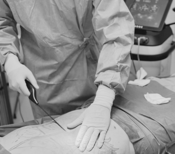 Buikcontour verbeterd met liposuctie en QuantumRF