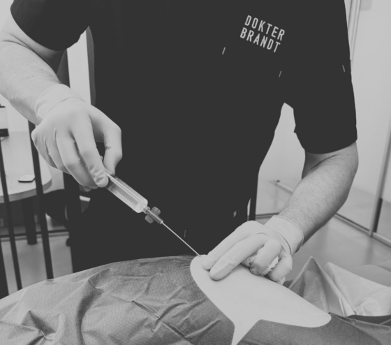 Billen geavanceerd behandeld met liposuctie, QuantumRF en Morpheus8 + stamcellen