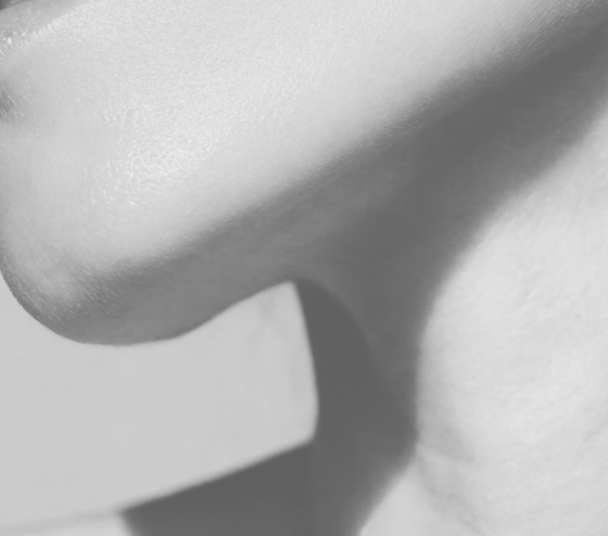 Onderkin liposuctie met QuantumRF uitgevoerd door dokter Brandt voor een strakkere kaaklijn.