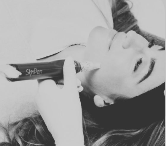 SkinPen microneedling behandeling voor huidverbetering bij Kliniek Dokter Brandt in Amsterdam