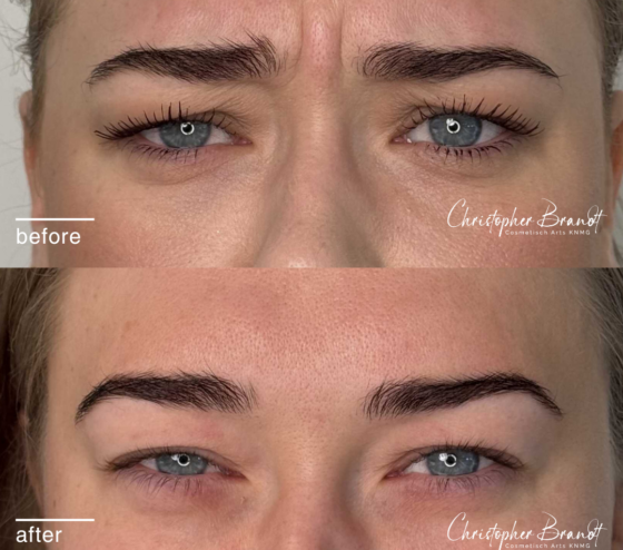 Voor en na resultaat van Botox fronsbehandeling bij Kliniek Dokter Brandt in Amsterdam, met zichtbaar verzachte fronsrimpels