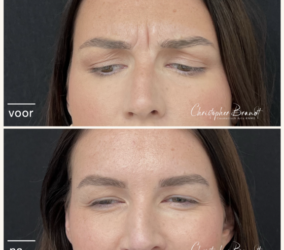 Voor en na resultaat van Botox fronsbehandeling bij Kliniek Dokter Brandt in Amsterdam, met zichtbaar verzachte fronsrimpels