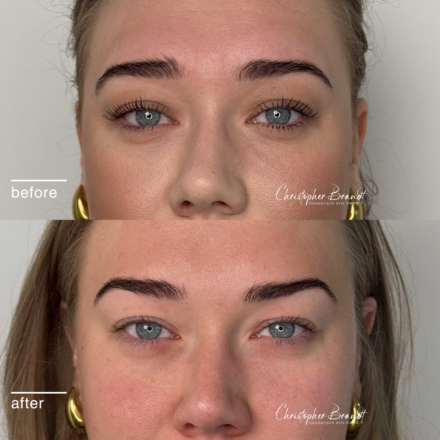 Voor en na resultaat van Botox behandeling tegen fronsrimpels bij Kliniek Dokter Brandt in Amsterdam