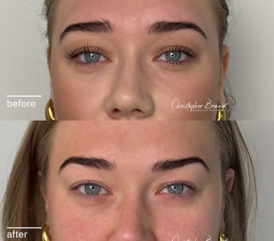 Voor en na resultaat van Botox behandeling tegen fronsrimpels bij Kliniek Dokter Brandt in Amsterdam