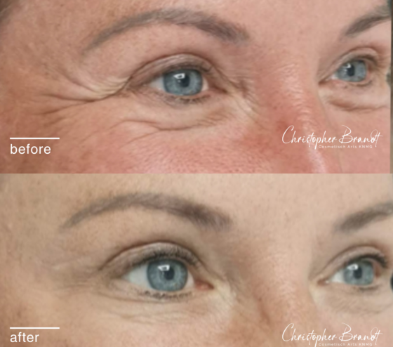 Botox Treatments Amsterdam