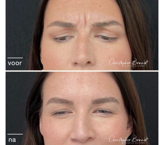 Voor en na resultaat van een Botox behandeling voor fronsrimpels tussen de wenkbrauwen