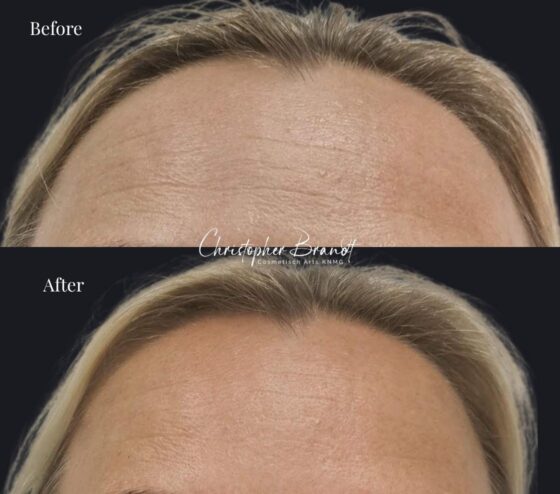 Botox Treatments Amsterdam kliniek Dokter Brandt 