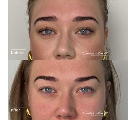 eyebrow lift 