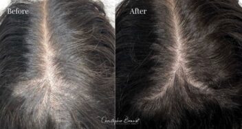haarbehandeling met stamcellen amsterdam