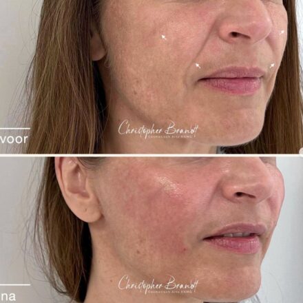 Liquid Facelift – Before & After Results
