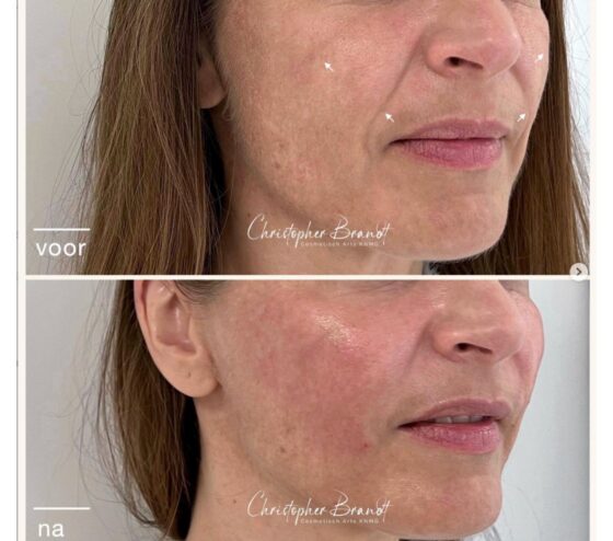 liquid facelift amsterdam 