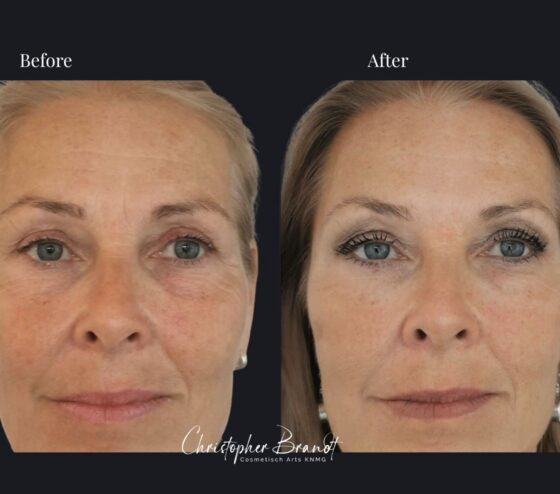 liquid facelift - minilift amsterdam