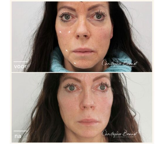 filler treatment amsterdam