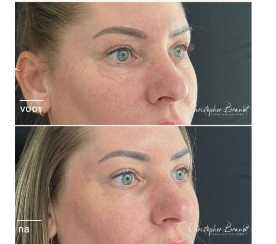 Before and after Plexr treatment bij Kliniek Dokter Brandt in Amsterdam