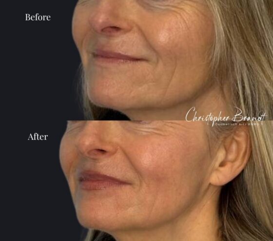 Before and after Plexr treatment bij Kliniek Dokter Brandt in Amsterdam