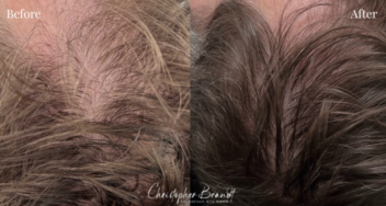 Voor en na resultaat van een stamcelbehandeling voor haarverlies en haarherstel