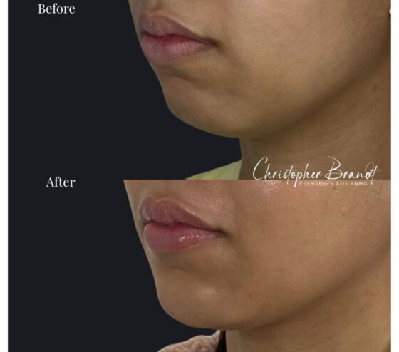 jawline treatment for enhanced jawline definition and facial