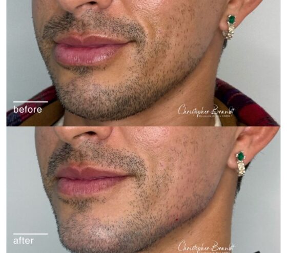jawline treatment 