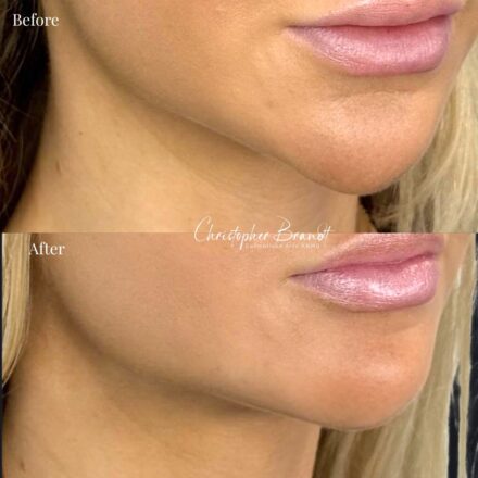 Voor en na foto van Radiesse behandeling van de kin en kaaklijn voor een strakkere jawline.
