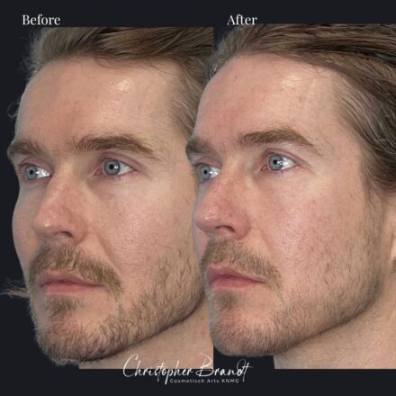 Voor- en nafoto van een Microfat stamcelbehandeling van het gezicht met zichtbare verbetering van huidkwaliteit en volume.