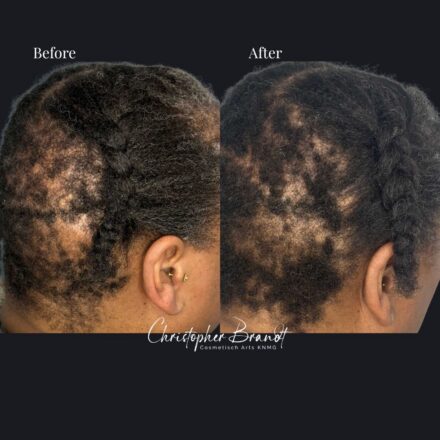 Voor- en nafoto van een haarstamcelbehandeling met zichtbare verbetering van haardichtheid en haargroei.