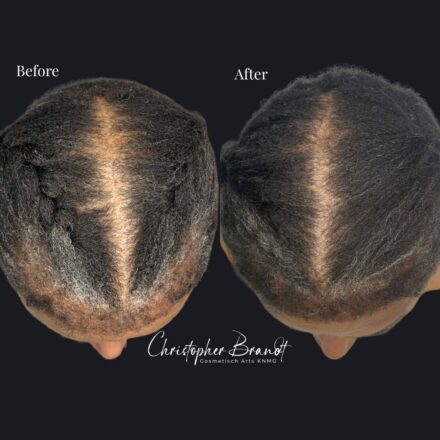 Voor- en nafoto van een haarstamcelbehandeling met zichtbare verbetering van haardichtheid en haargroei.