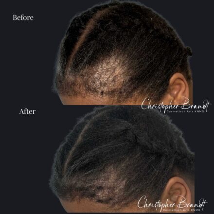 Voor- en nafoto van een haarstamcelbehandeling met zichtbare verbetering van haardichtheid en haargroei.