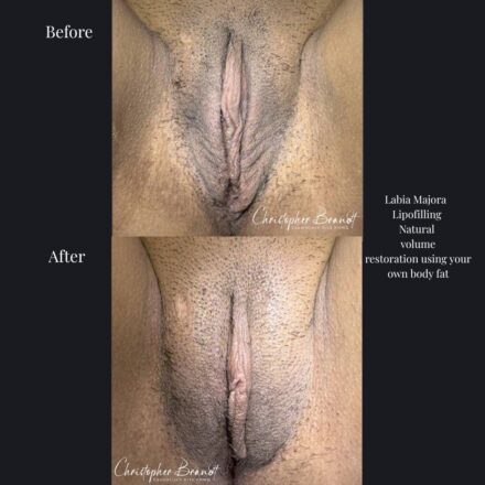 Lipofilling van de buitenste schaamlippen met lichaamseigen vet voor natuurlijk volumeherstel.