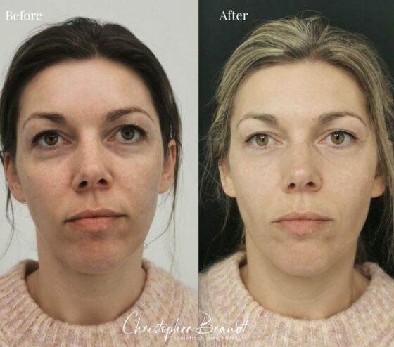 Endolift Treatment Netherlands