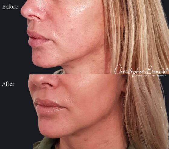 Endolift Treatments Amsterdam